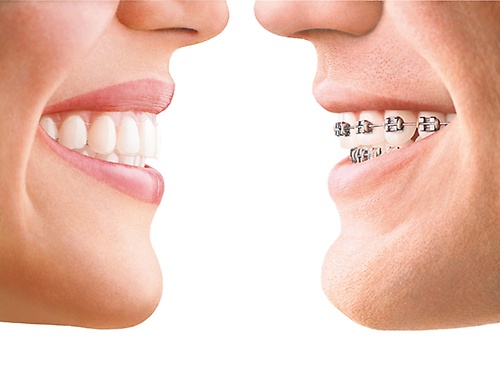 We offer both Invisalign (clear option to straighten your teeth) and traditional braces.