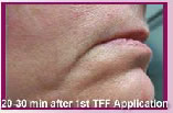 30 min after TFF application 30 min after TFF application