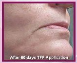 60 days after TFF application 60 days after TFF application