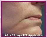 30 days after TFF application 30 days after TFF application