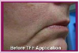 Before TFF application Before TFF application