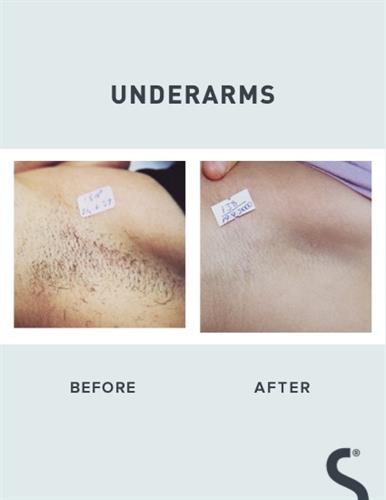 Underarm results after a few sessions 