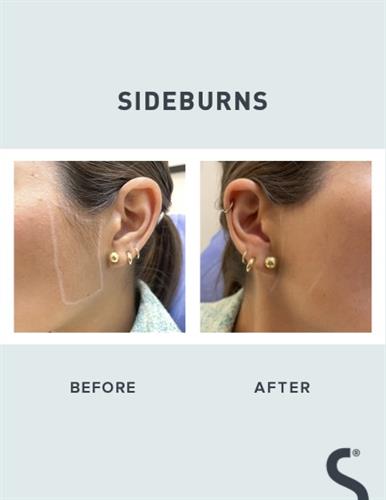 Sideburn results after a few sessions