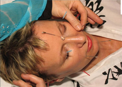 Gallery Image Gold_Standard_Facial_Acupuncture.png