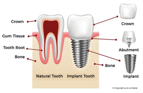 Dental Implant Illustration 
