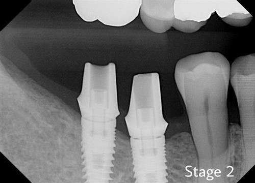 Dental Implant Stage 2 