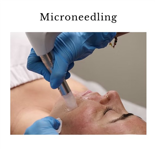 Microneedling or induced collagen therapy is an effective treatment to reduce fine wrinkles, pigmentation, scars , large pores and overall skin texture and elasticity.