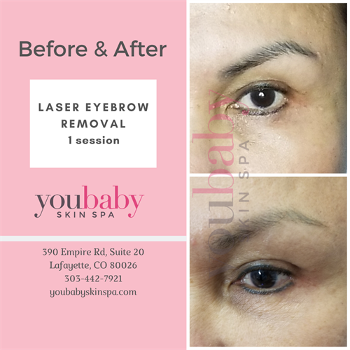 Permanent Makeup Correction - Removal of permanent makeup