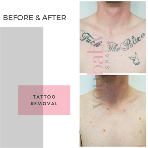 Don't let the tattoo from your past haunt you the rest of your life. Remove it here!