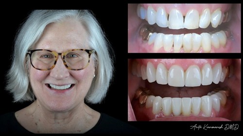 Before and after