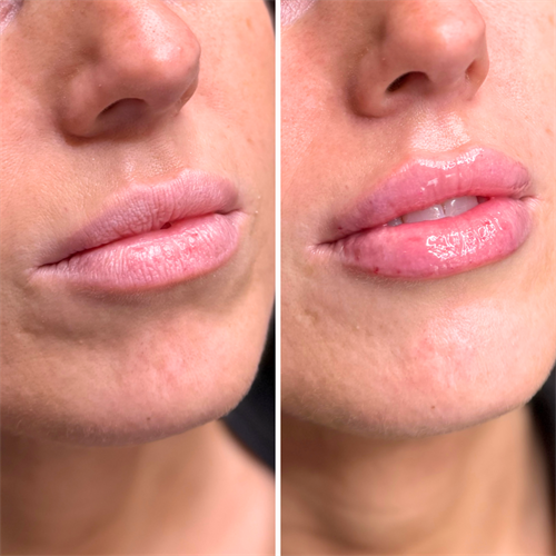 Lips Before/After