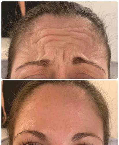 Gallery Image botox.jpeg