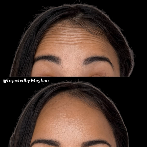 Wrinkle Relaxation with Neuromodulators (Botox, Xeomin, Nuceiva, Dysport)