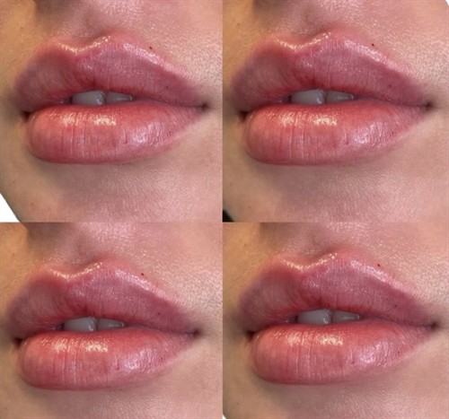 Lip Filler After Photo