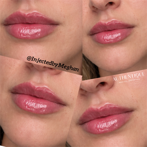 Lip Filler After Photo