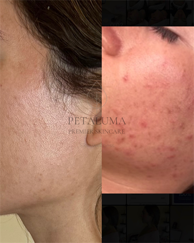 Acne reset method - structured program to clear acne 