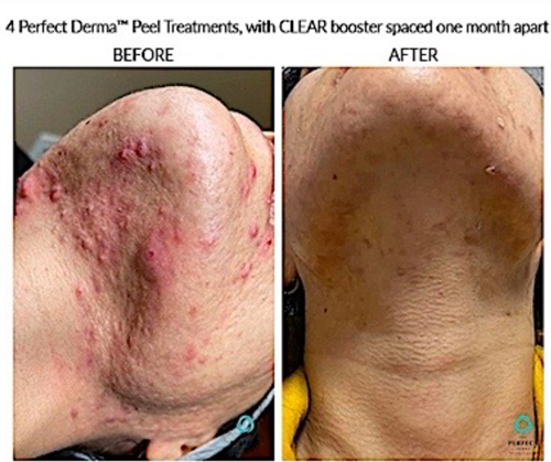 Experience the magic of the Perfect derma peel! Stubborn acne and Melasma is in the past.