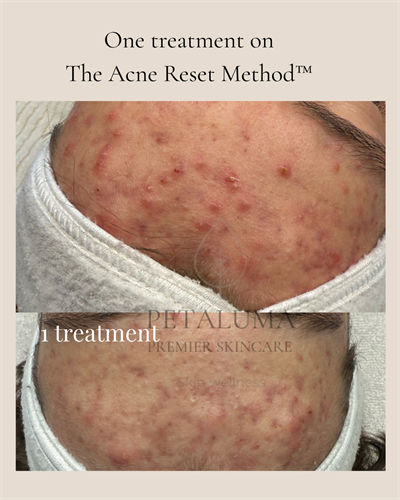 Just 1 treatment on the acne reset method! Cystic acne doesn’t have to be a regular occurrence!