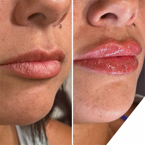 Lip Filler by Top 100 Master Injector Natacha