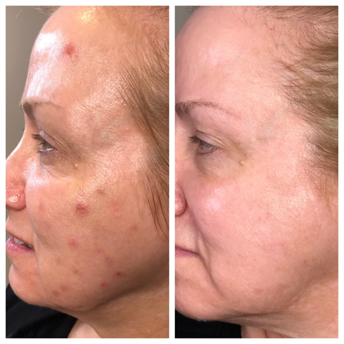 Series of Chemical Peels for acne and acne scars