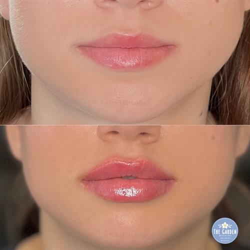 Lip Filler by Natacha Christeler 