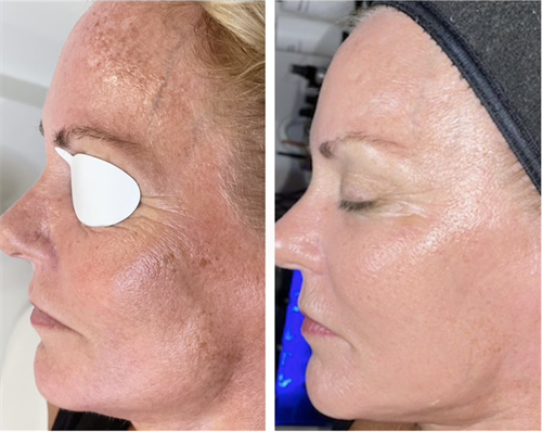 SmoothGlo by Laser Expert Dr. Michael Mirmanesh, MD.