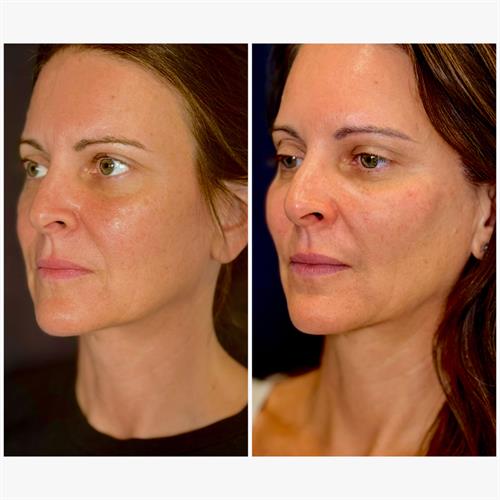 Temple & Cheek Filler Before & After