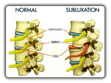 Gallery Image subluxation_with_vertebral_shift.png Gallery Image subluxation_with_vertebral_shift.png