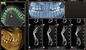 3D Imaging for precise implant placement