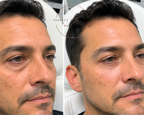Under-eye Rejuvenation 