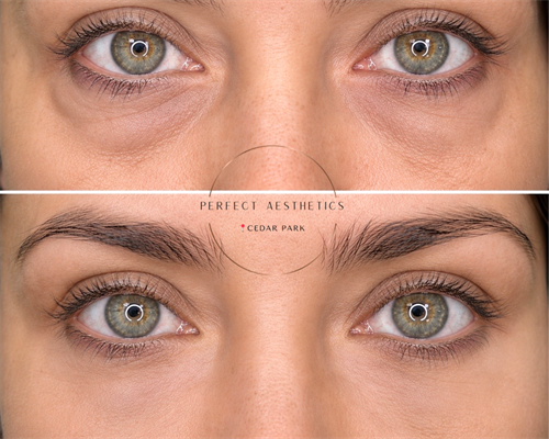 Under-eye Rejuvenation 