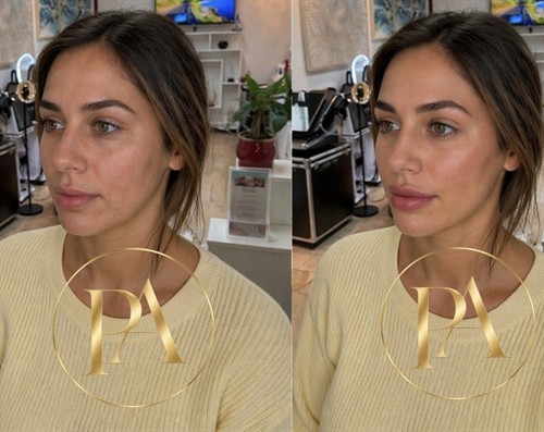 Facial Balancing 