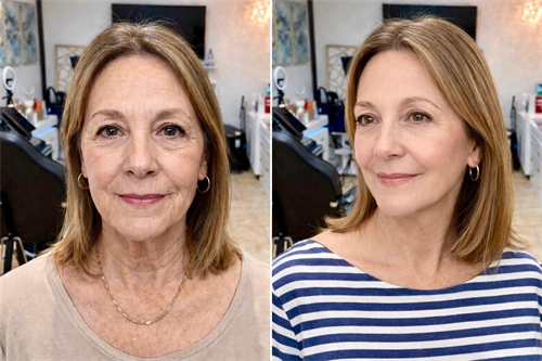 Facial balancing with Sculptra and cheek filler to restore volume, improve facial harmony, and create natural-looking anti-aging results.
