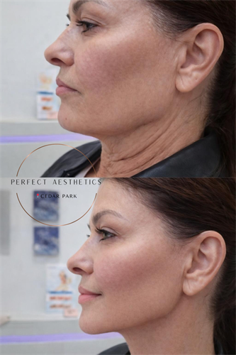 Jawline contour 