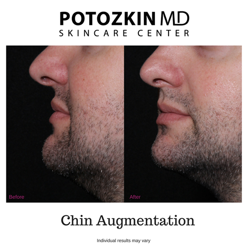 Chin Augmentation with Filler 