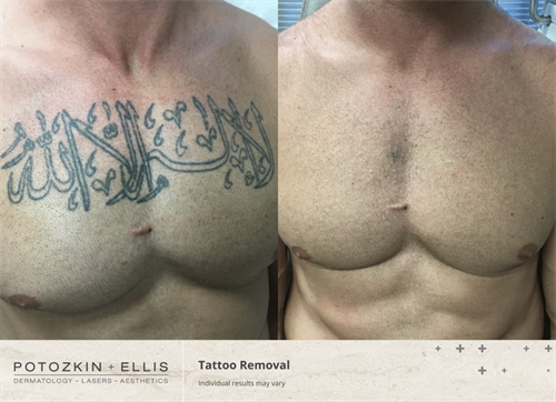 Before and After of PicoWay Laser Tattoo Removal
