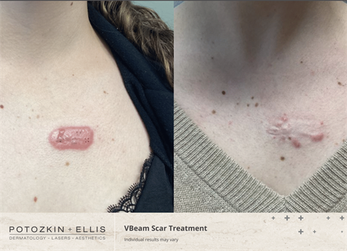 Before and After of VBeam Scar Treatment