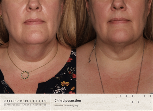Before and After of Chin Liposuction