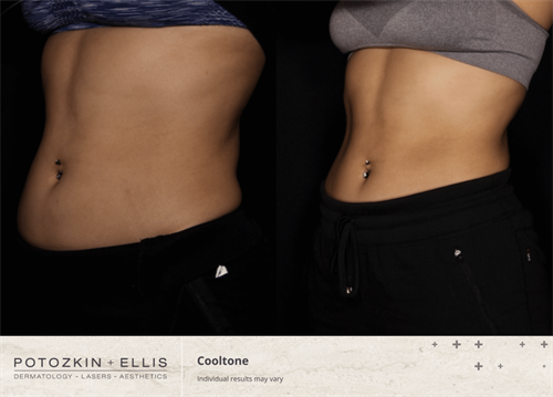 Before and After of Cooltone Treatment