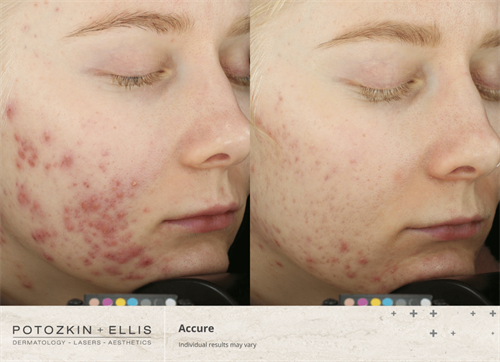 Before and After of Cooltone Accure Treatment