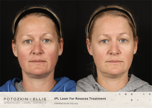 Before and After of Rosacea Treatment