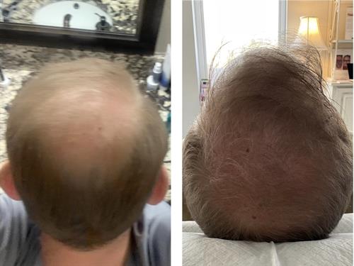 hair restoration that works- no down time!