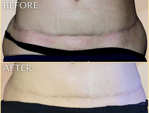 Morpheus 8 RF microneedling for reduction in surgical scars