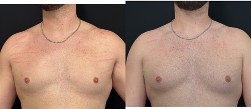 Morpheus 8 RF microneedling for reduction in the appearance of stretch marks