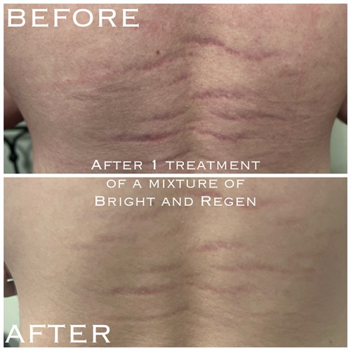 Stretch Mark Repair
