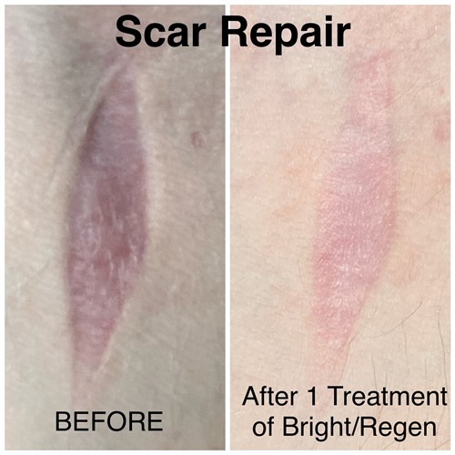 Scar Repair