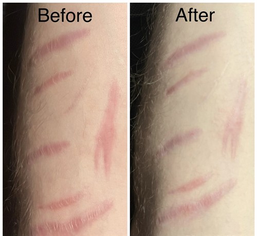 Scar Repair