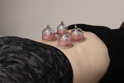 Cupping