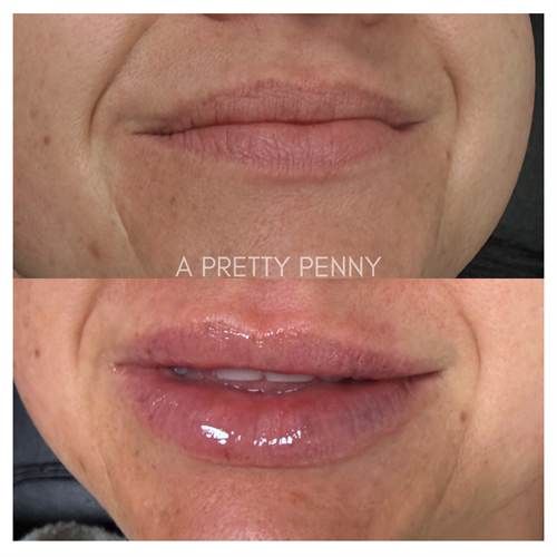 lip filler