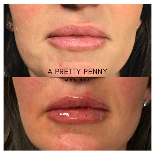 Lip filler